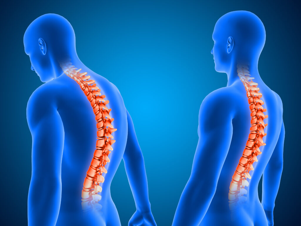 Scoliosis diagnosis is a crucial step in understanding the extent of spinal curvature