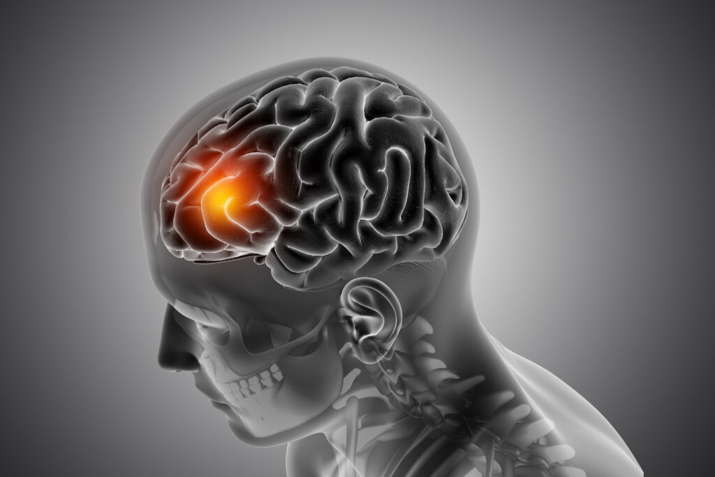 Physical therapy can be helpful for a stroke victim