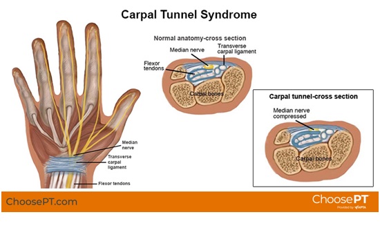 carpal-tunnel-syndrome-treatment-with-physical-therapy