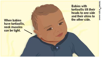 infant torticollis treatment in brooklyn new york