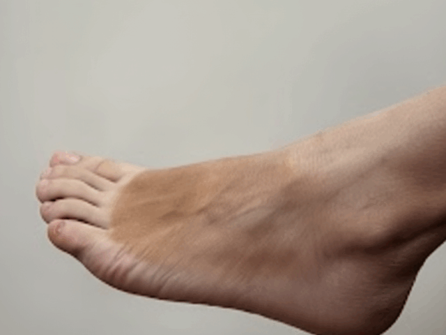 Foot Drop in Children: What to Look For and How Therapy-In-Motion Can Help